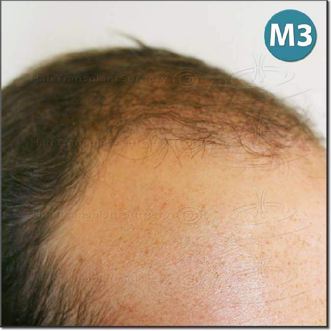 Dr.Devroye-HTS-Clinic-2987-FUT-NW-IV-14.jpg