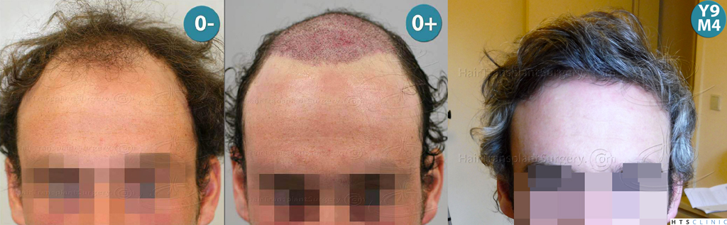 Dr.Devroye-HTS-Clinic-2987-FUT-NW-IV-Montage5.jpg