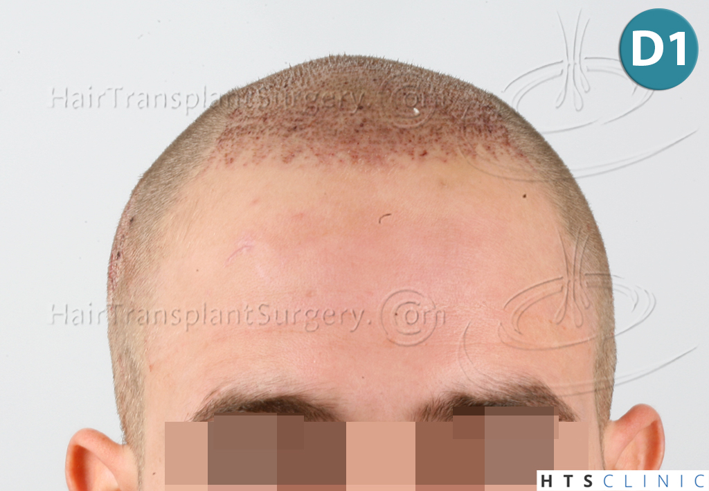 Dr.Devroye-HTS-Clinic-2074-FUE-7.jpg