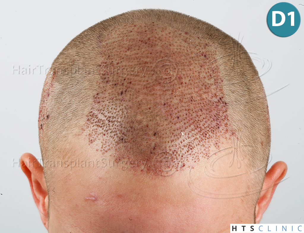 Dr.Devroye-HTS-Clinic-2074-FUE-8.jpg