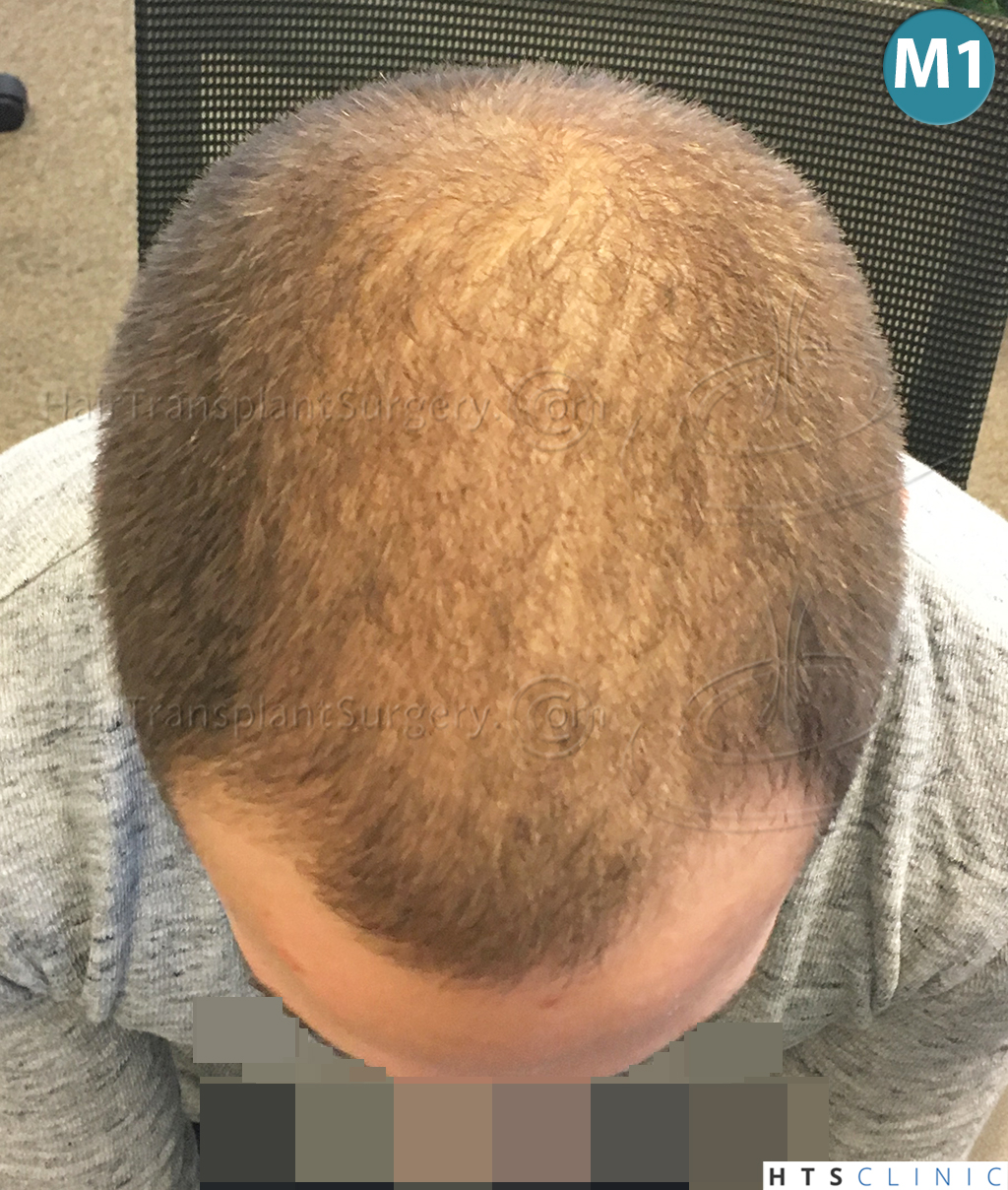 Dr.Devroye-HTS-Clinic-2074-FUE-11.jpg