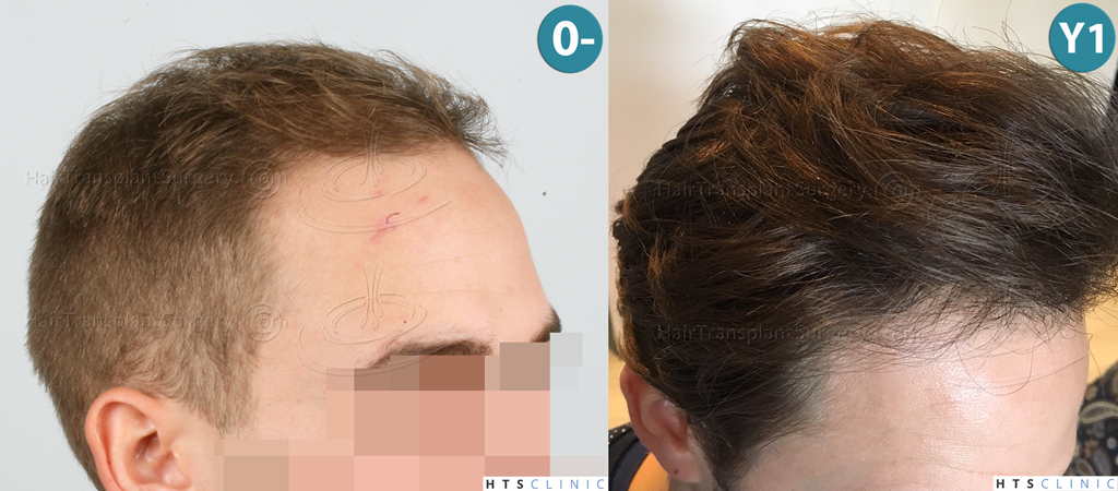 Dr.Devroye-HTS-Clinic-2074-FUE-Montage4.jpg