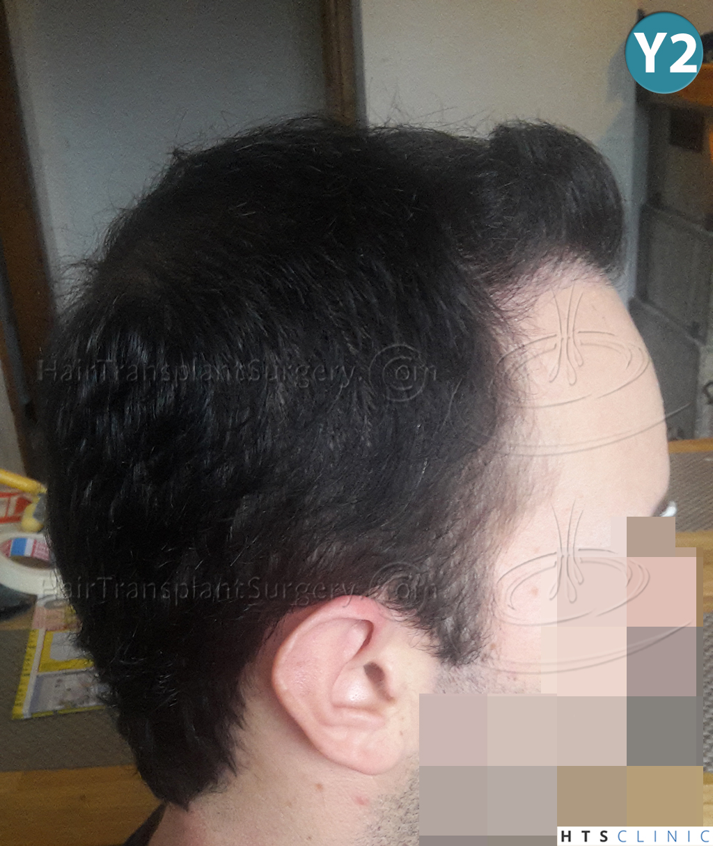 Dr.Devroye-HTS-Clinic-3840-FUT-849-FUE-Combo-Repair-21.jpg