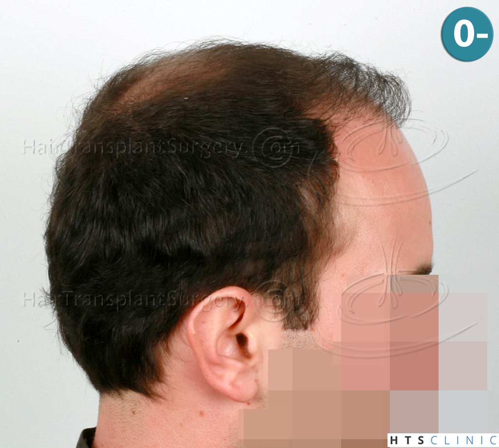 Dr.Devroye-HTS-Clinic-3840-FUT-849-FUE-Combo-Repair-4.jpg