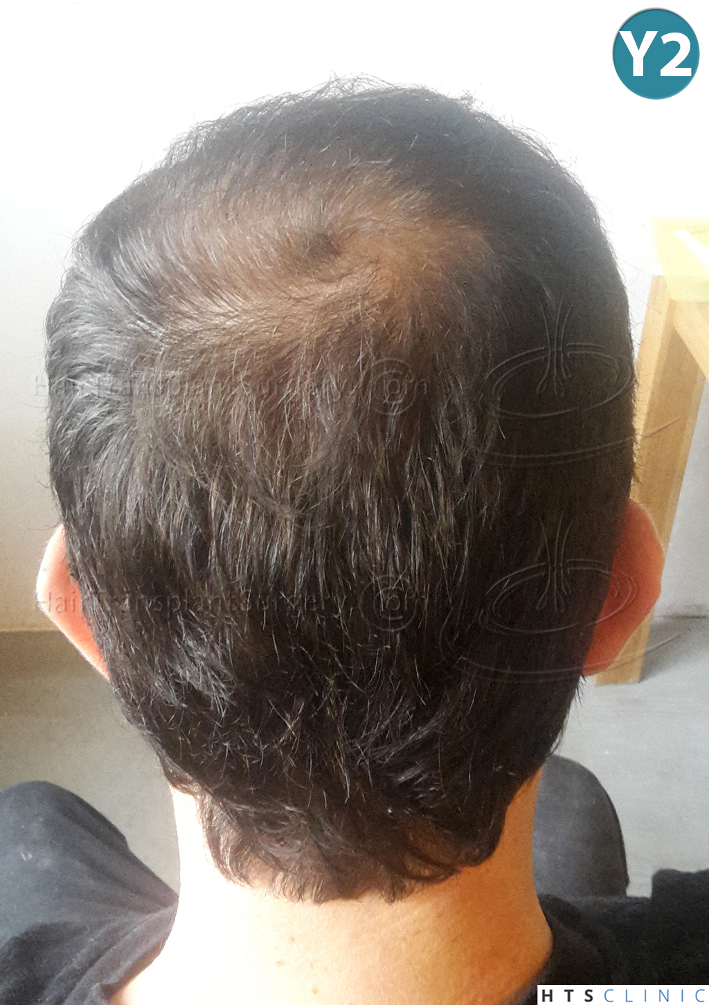 Dr.Devroye-HTS-Clinic-3840-FUT-849-FUE-Combo-Repair-23.jpg