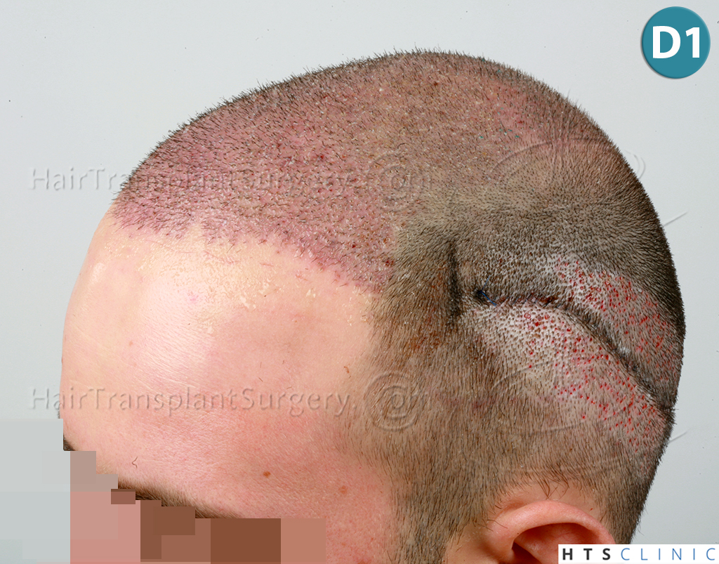 Dr.Devroye-HTS-Clinic-3840-FUT-849-FUE-Combo-Repair-10.jpg