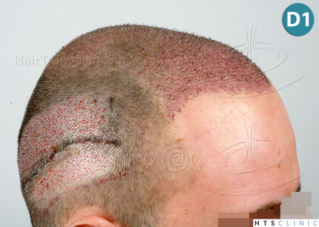 Dr.Devroye-HTS-Clinic-3840-FUT-849-FUE-Combo-Repair-11.jpg