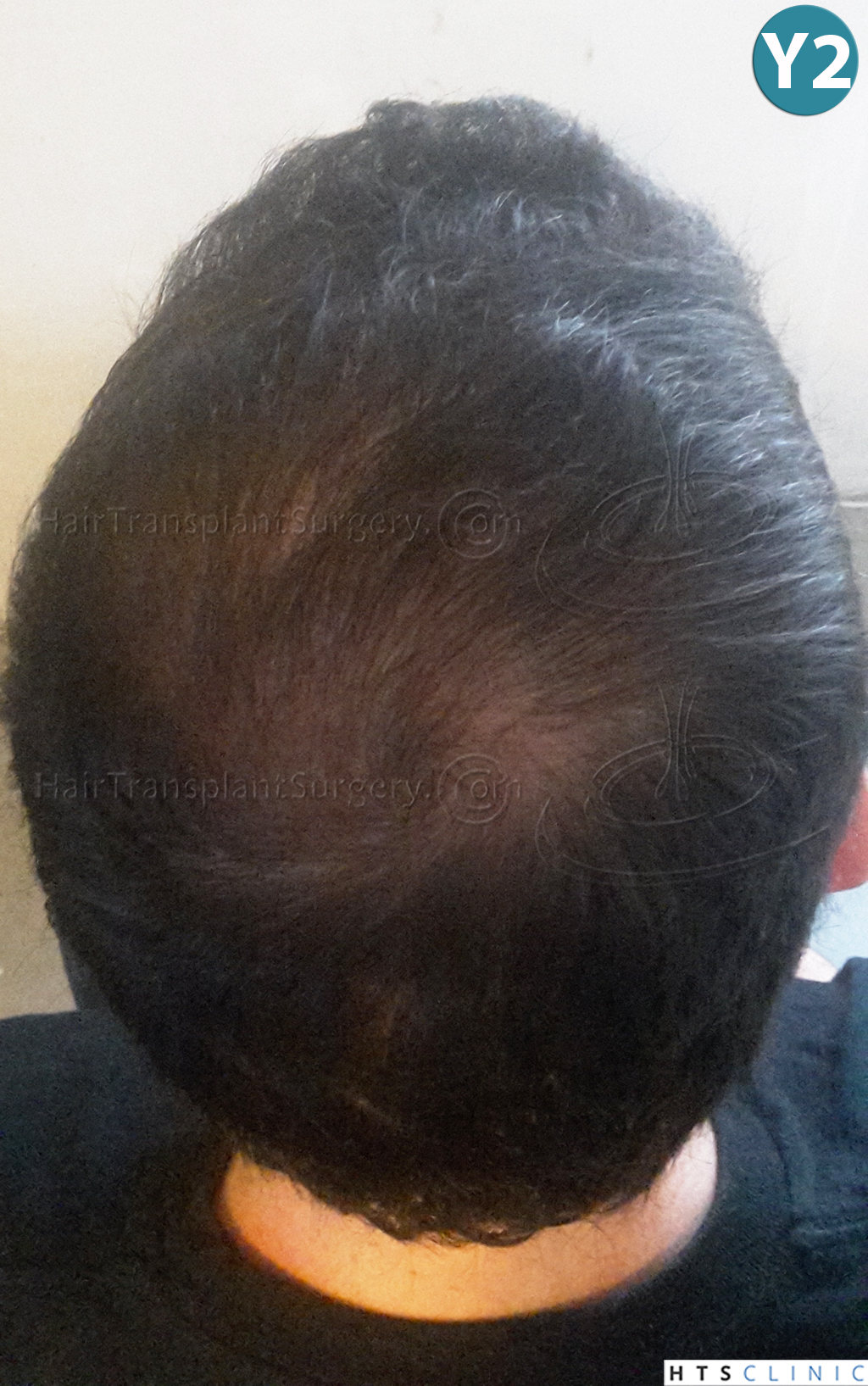 Dr.Devroye-HTS-Clinic-3840-FUT-849-FUE-Combo-Repair-25.jpg