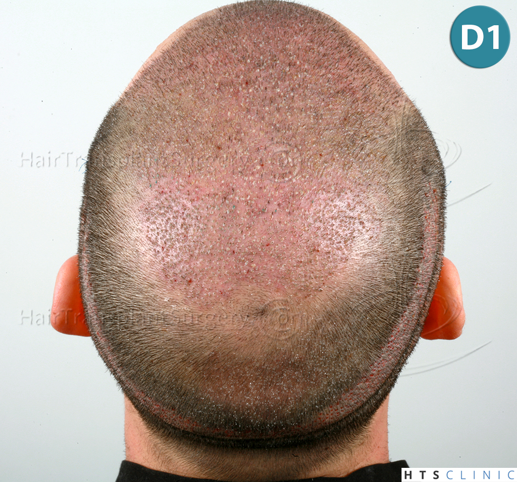 Dr.Devroye-HTS-Clinic-3840-FUT-849-FUE-Combo-Repair-12.jpg