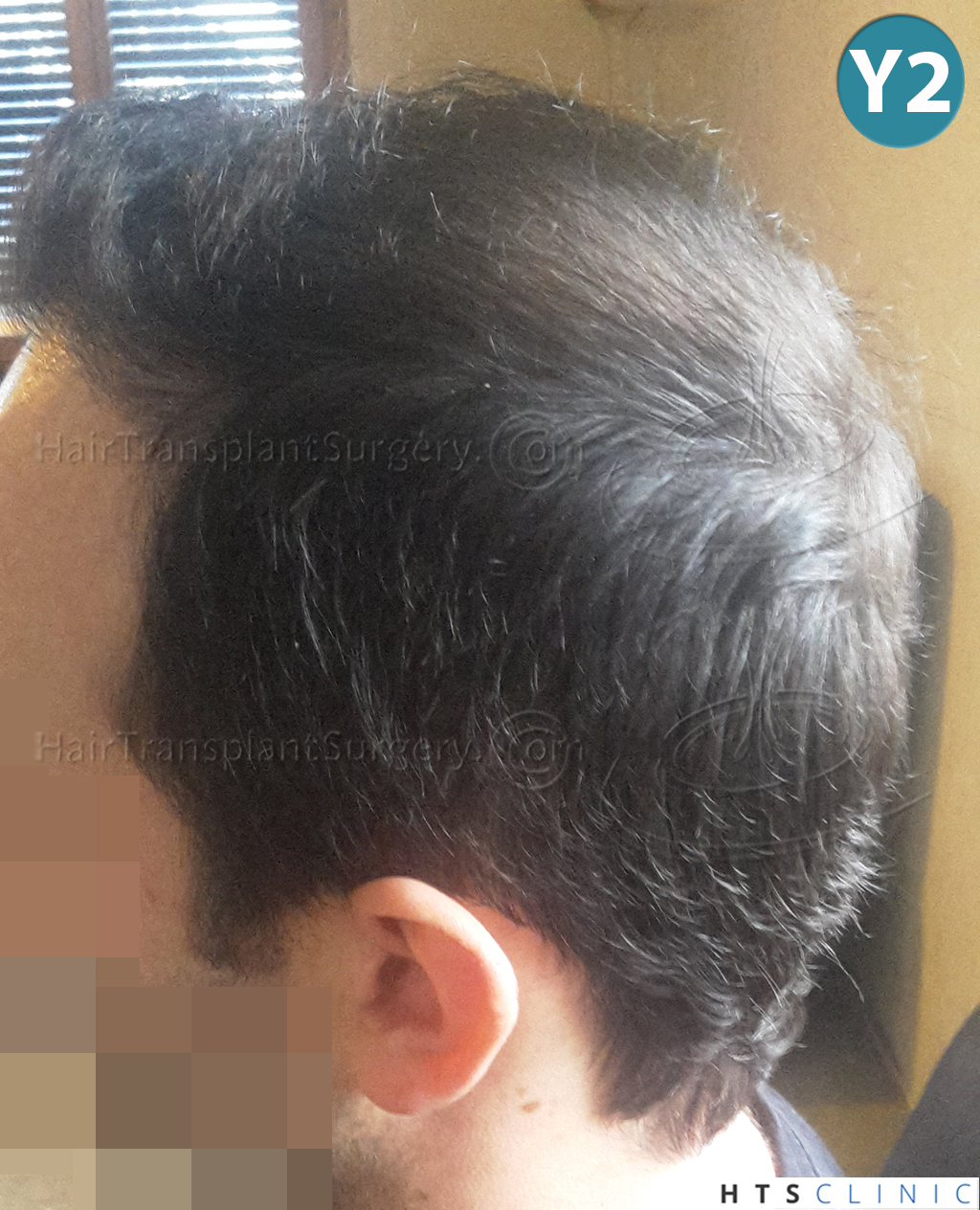 Dr.Devroye-HTS-Clinic-3840-FUT-849-FUE-Combo-Repair-18.jpg