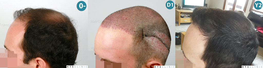 Dr.Devroye-HTS-Clinic-3840-FUT-849-FUE-Combo-Repair-Montage3.jpg