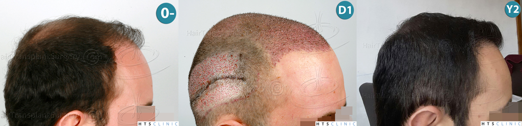 Dr.Devroye-HTS-Clinic-3840-FUT-849-FUE-Combo-Repair-Montage4.jpg