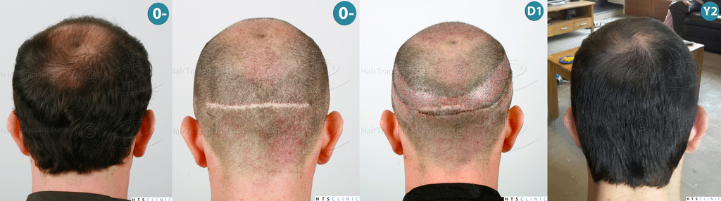 Dr.Devroye-HTS-Clinic-3840-FUT-849-FUE-Combo-Repair-Montage6.jpg