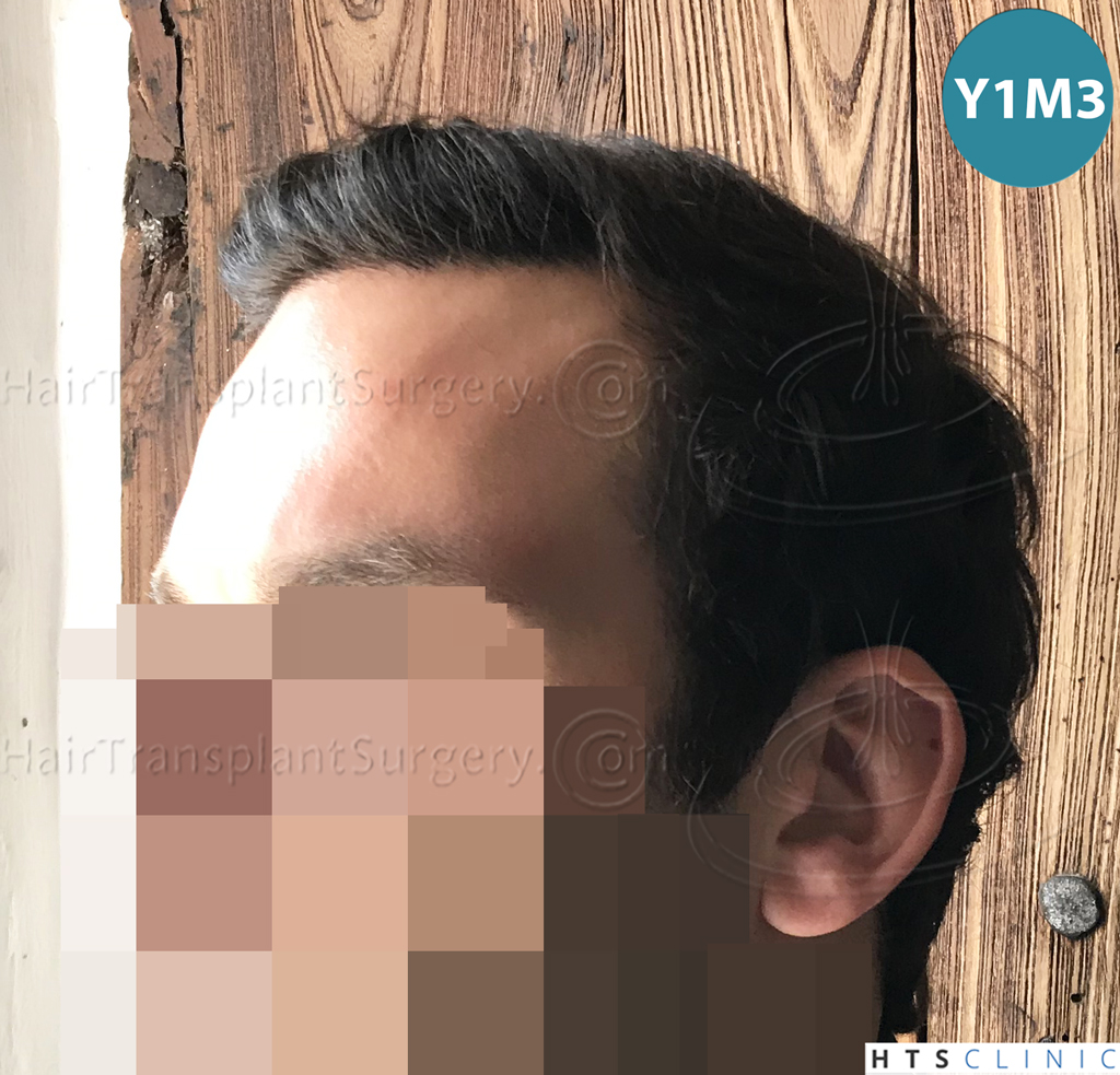 Dr.Devroye-HTS-Clinic-4658-FUT-1156-FUE-Combo-23.jpg