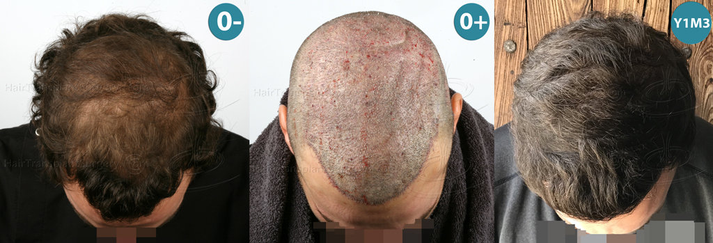 Dr.Devroye-HTS-Clinic-4658-FUT-1156-FUE-Combo-Montage2.jpg