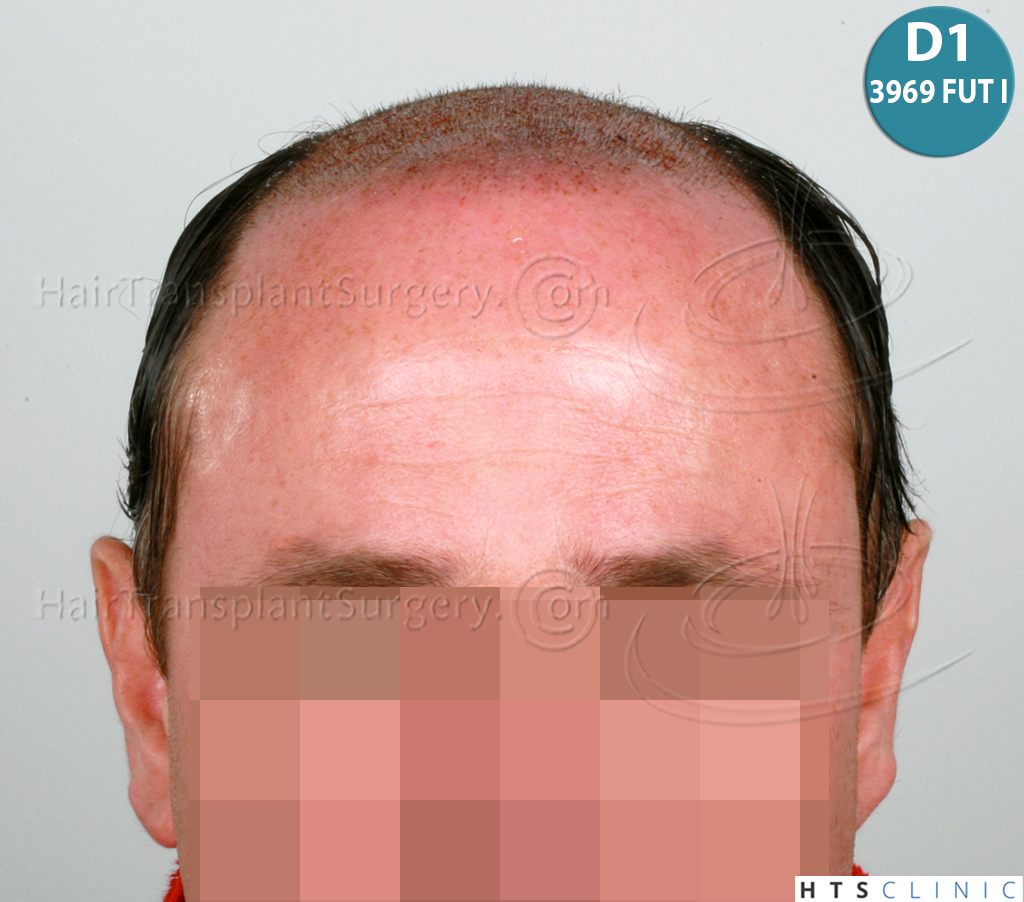 Dr.Devroye-HTS-Clinic-6910-FUT-_3969_2941_-NW-VI-7.jpg