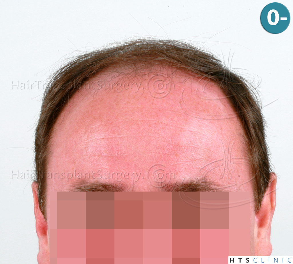 Dr.Devroye-HTS-Clinic-6910-FUT-_3969_2941_-NW-VI-1.jpg