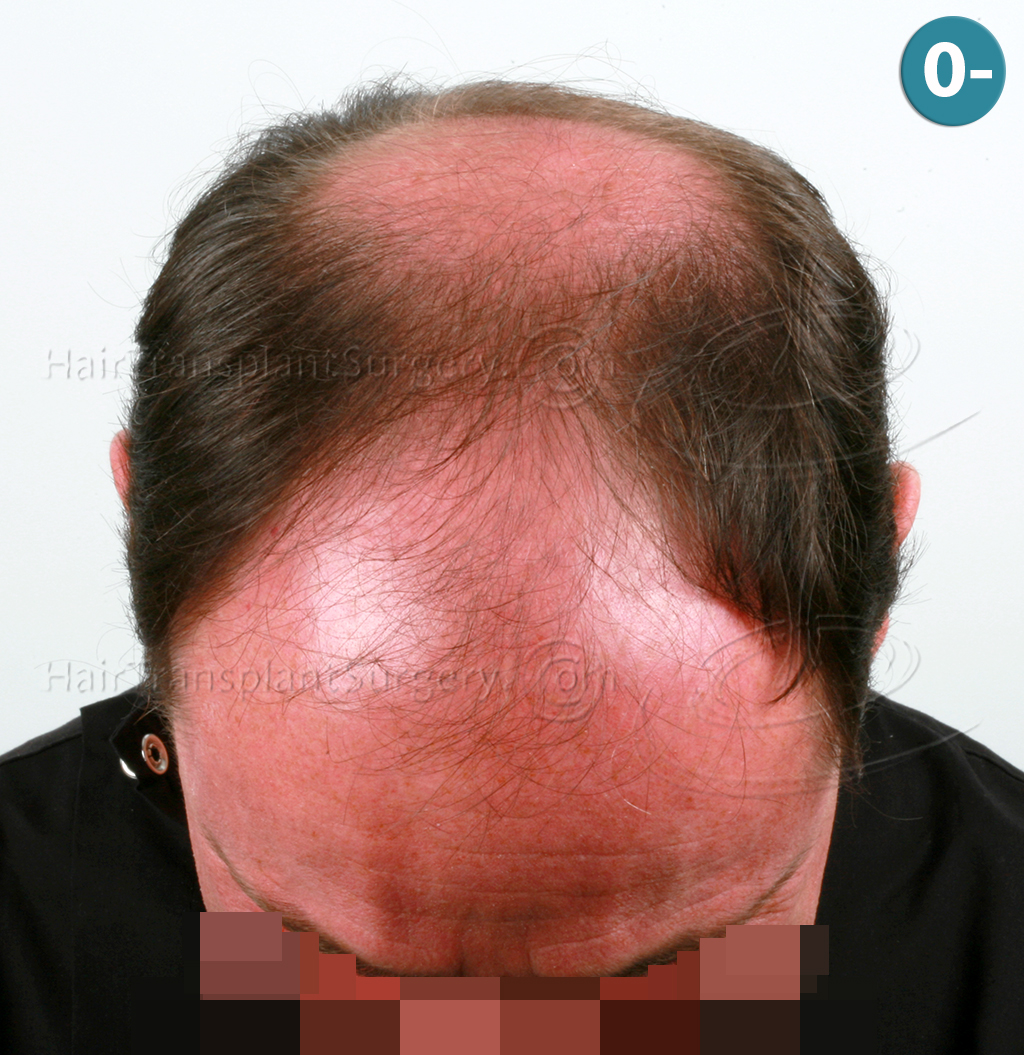 Dr.Devroye-HTS-Clinic-6910-FUT-_3969_2941_-NW-VI-2.jpg