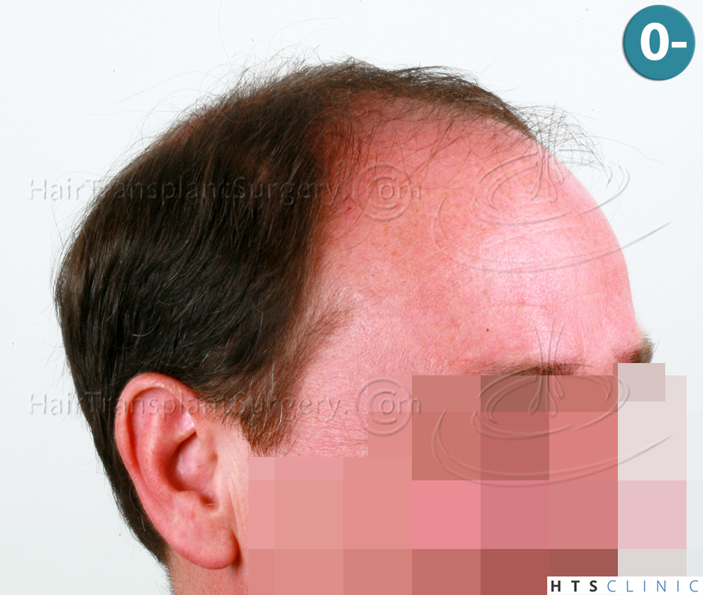 Dr.Devroye-HTS-Clinic-6910-FUT-_3969_2941_-NW-VI-4.jpg