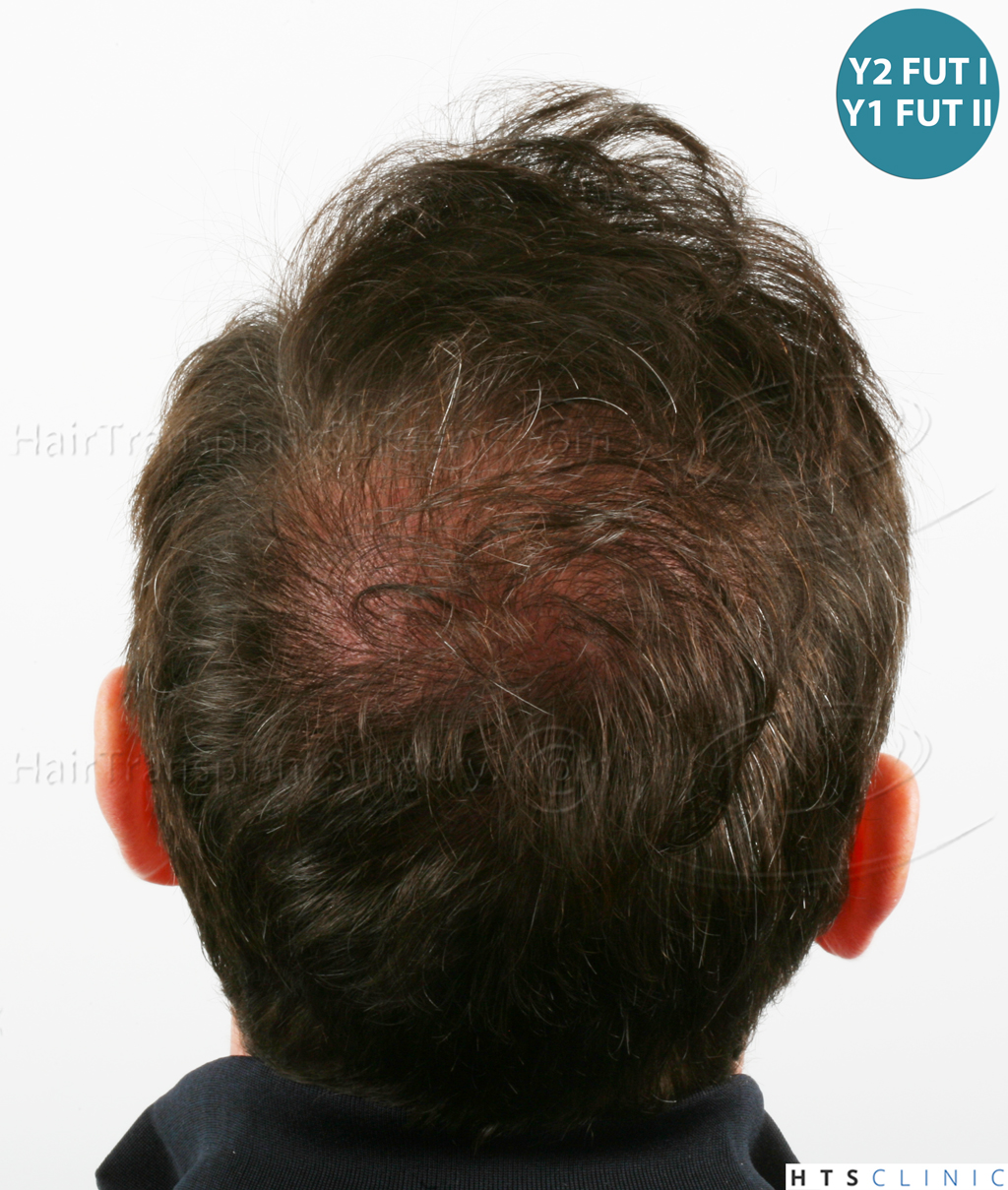 Dr.Devroye-HTS-Clinic-6910-FUT-_3969_2941_-NW-VI-26.jpg