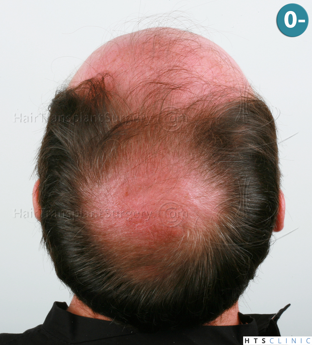 Dr.Devroye-HTS-Clinic-6910-FUT-_3969_2941_-NW-VI-6.jpg