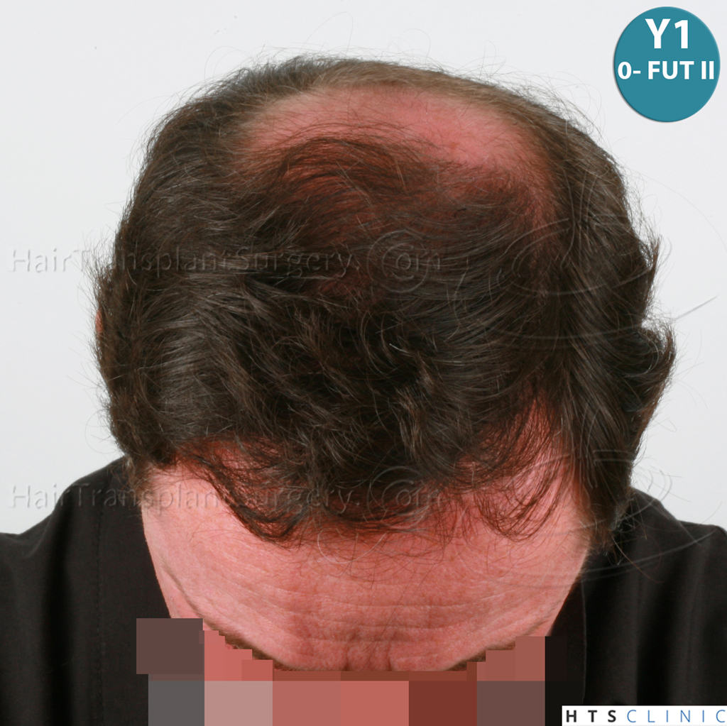 Dr.Devroye-HTS-Clinic-6910-FUT-_3969_2941_-NW-VI-11.jpg