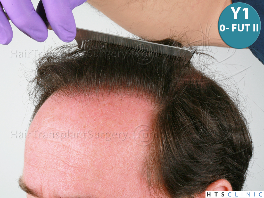 Dr.Devroye-HTS-Clinic-6910-FUT-_3969_2941_-NW-VI-12.jpg