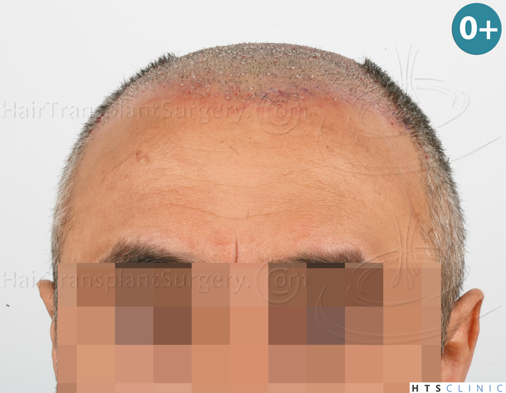 Dr.Devroye-HTS-Clinic-1406-FUE-II-6.jpg