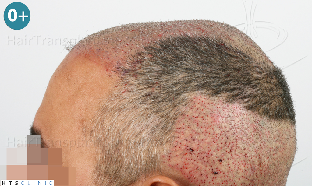 Dr.Devroye-HTS-Clinic-1406-FUE-II-8.jpg