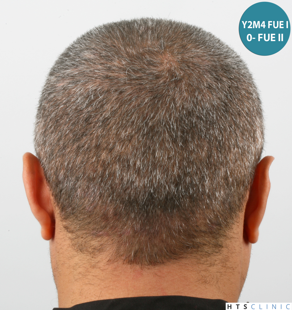 Dr.Devroye-HTS-Clinic-1406-FUE-II-4.jpg