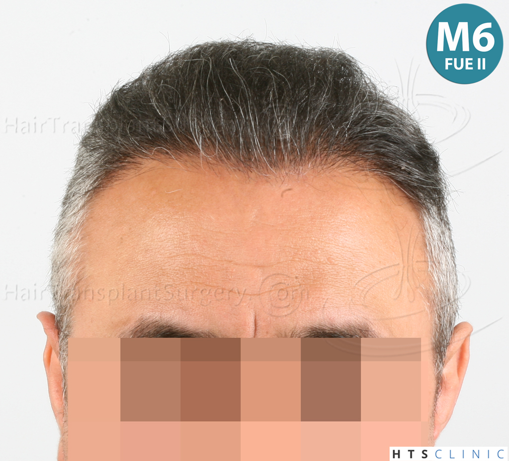 Dr.Devroye-HTS-Clinic-1406-FUE-II-13.jpg