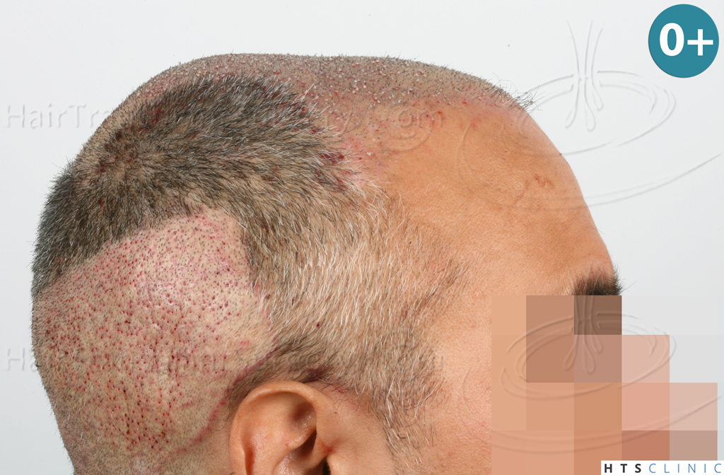 Dr.Devroye-HTS-Clinic-1406-FUE-II-9.jpg