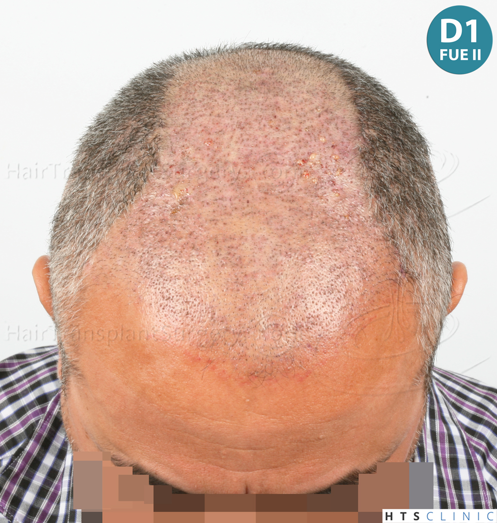 Dr.Devroye-HTS-Clinic-1406-FUE-II-10.jpg