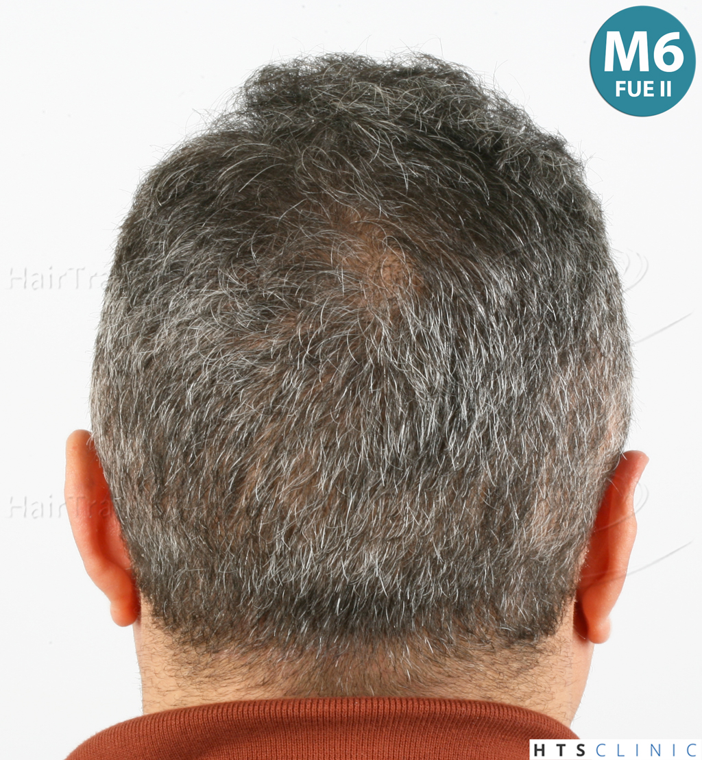 Dr.Devroye-HTS-Clinic-1406-FUE-II-16.jpg
