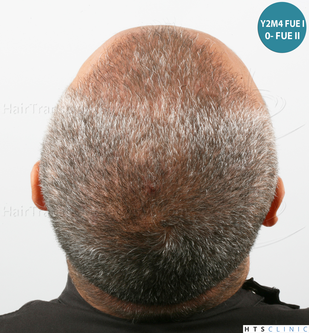 Dr.Devroye-HTS-Clinic-1406-FUE-II-5.jpg