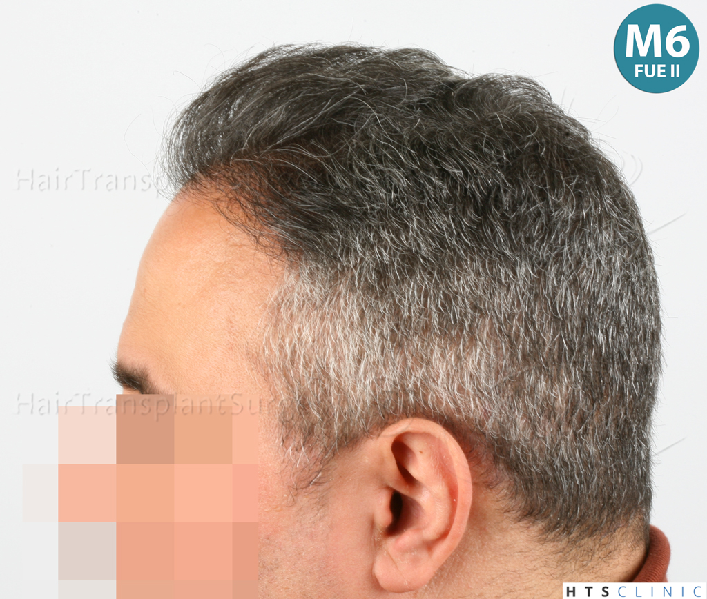 Dr.Devroye-HTS-Clinic-1406-FUE-II-14.jpg