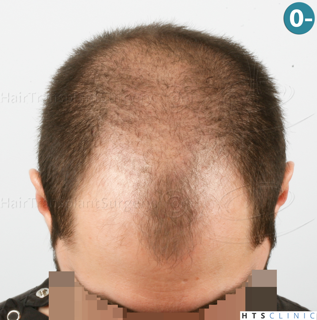 Dr.Devroye-HTS-clinic-3444-FUE-NW-V-2