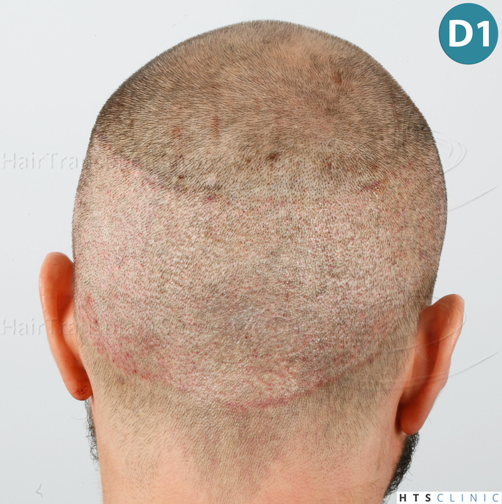 Dr.Devroye-HTS-clinic-3444-FUE-NW-V-11