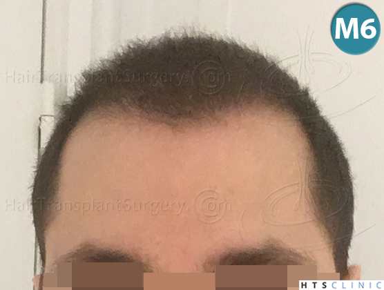 Dr.Devroye-HTS-clinic-3444-FUE-NW-V-16