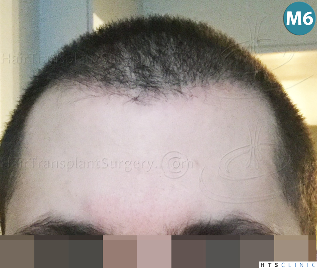 Dr.Devroye-HTS-clinic-3444-FUE-NW-V-17