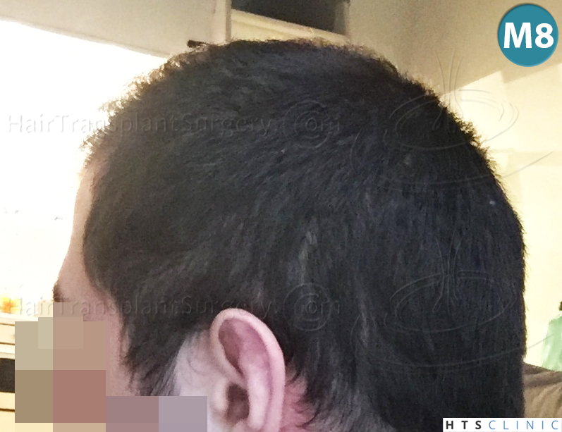 Dr.Devroye-HTS-clinic-3444-FUE-NW-V-29