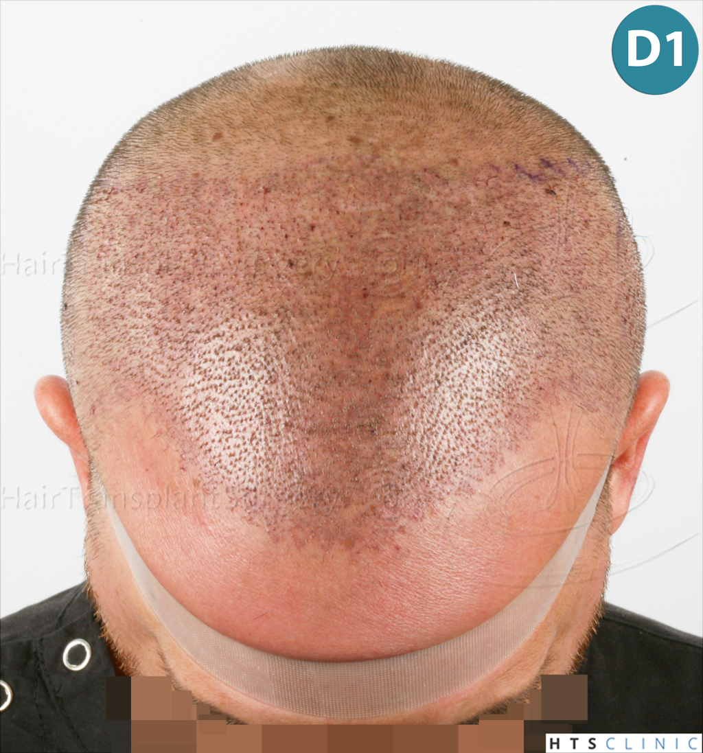 Dr.Devroye-HTS-clinic-3723-FUE-NW-IV-9.jpg