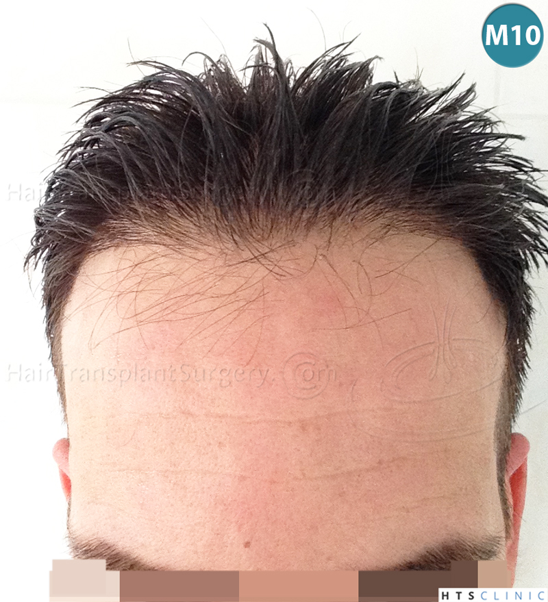 Dr.Devroye-HTS-clinic-3723-FUE-NW-IV-19.jpg