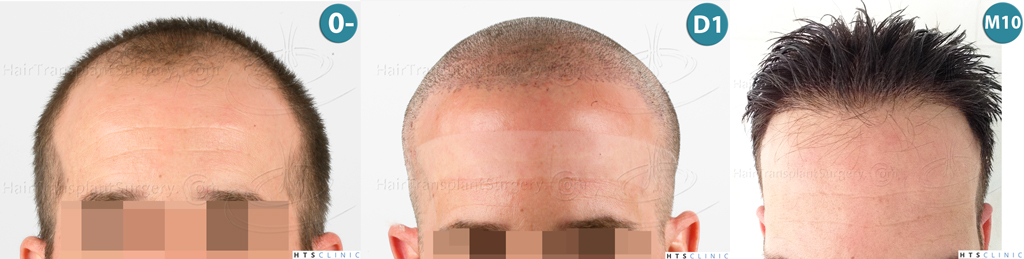 Dr.Devroye-HTS-clinic-3723-FUE-NW-IV-Montage1.jpg