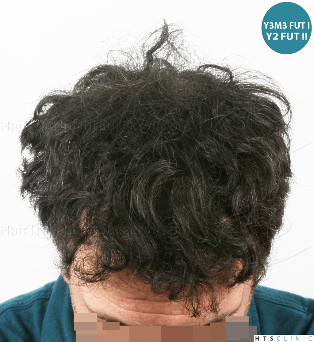 Dr.Devroye-HTS-Clinic-6428-FUT-_3708_2720_-NW-V-32.jpg