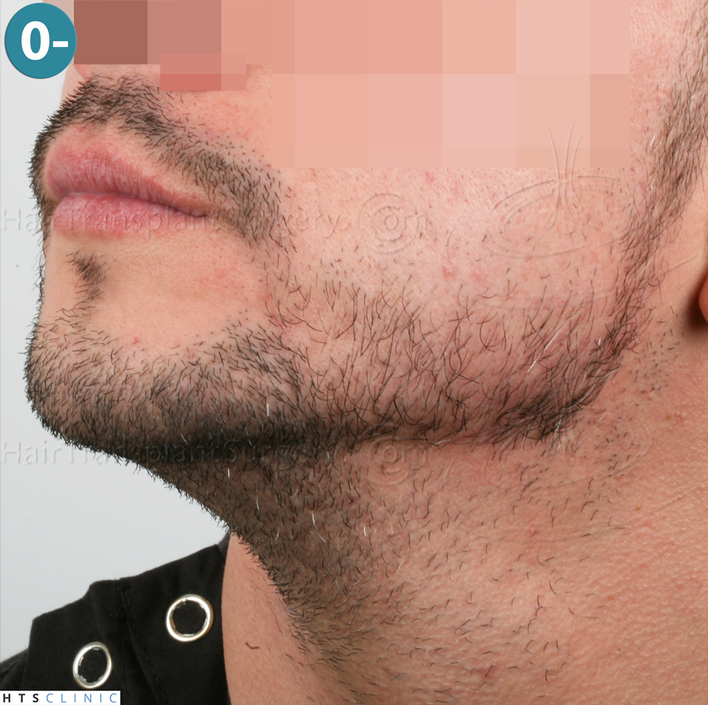 Dr.Devroye-HTS-Clinic-1011-FUE-Beard-2