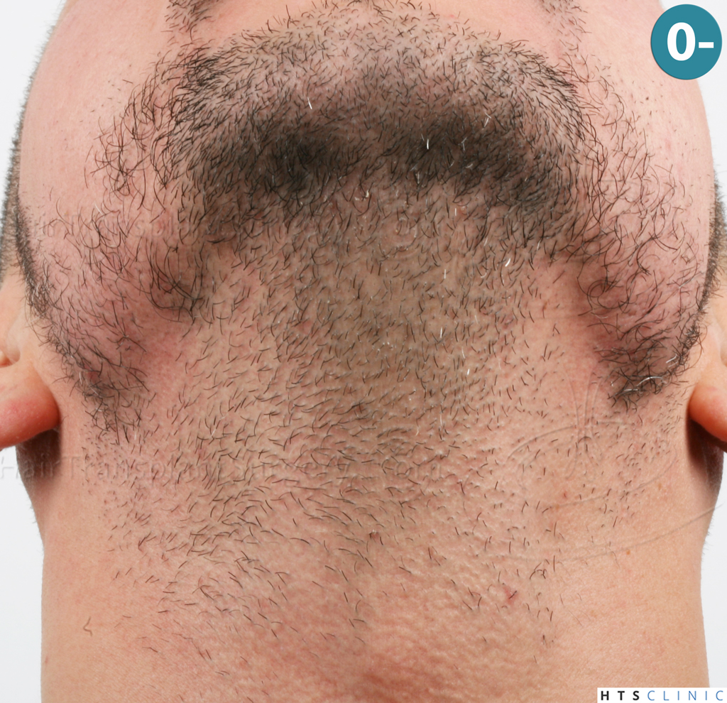 Dr.Devroye-HTS-Clinic-1011-FUE-Beard-4