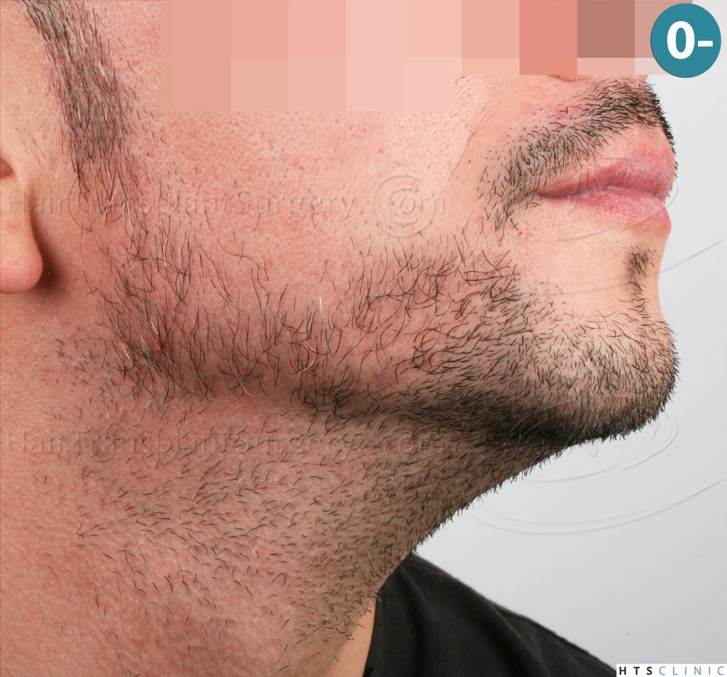 Dr.Devroye-HTS-Clinic-1011-FUE-Beard-3