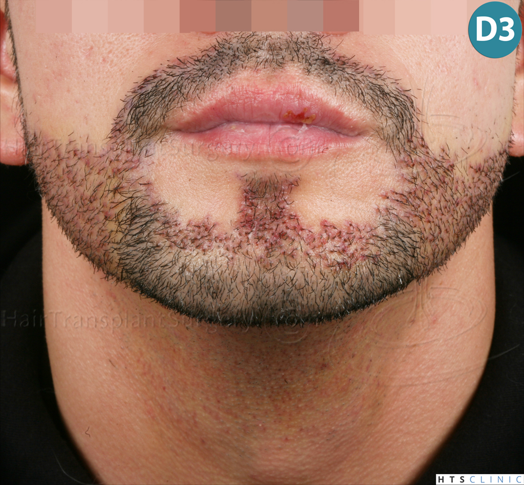 Dr.Devroye-HTS-Clinic-1011-FUE-Beard-12.jpg