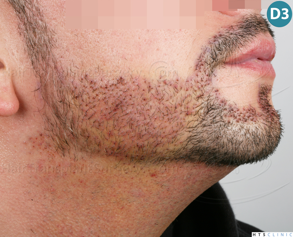 Dr.Devroye-HTS-Clinic-1011-FUE-Beard-14.jpg